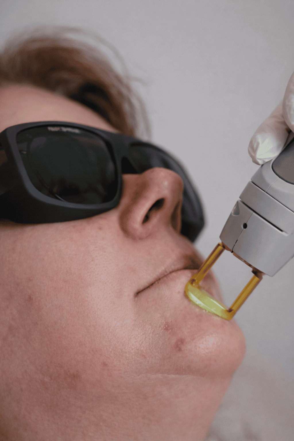 Laserbehandeling voor het verwijderen van kinhaartjes bij Clear Groningen