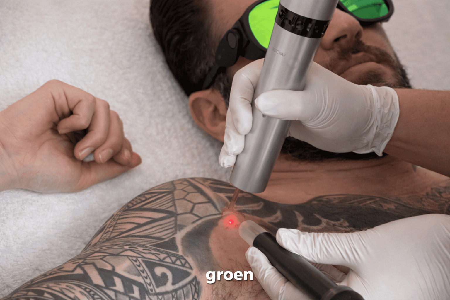 Close-up tattoo laseren borst. Kleurentattoo verwijderen